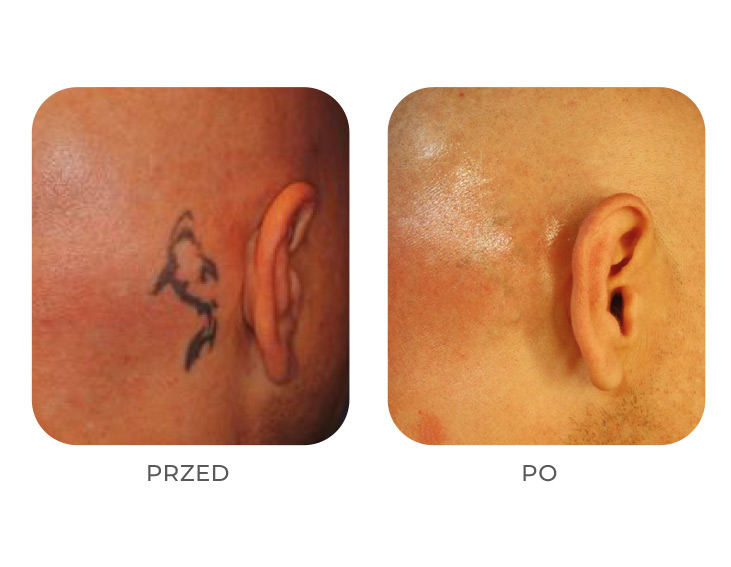 PicoSure usuwanie tatuażu efekty
